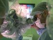 Новосибирские хирурги удалили женщине огромную опухоль мозга